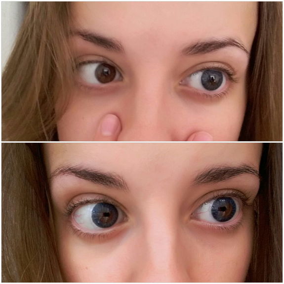 Как увеличить глаза упражнения фото до и после